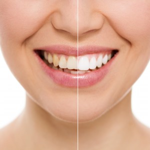 Flotte hvide tænder med tandafblegning
